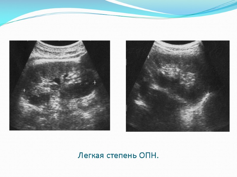 Легкая степень ОПН.